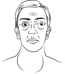 Observe the following picture, identify the defect and the cause of the defect. ICSE 2025 Biology Solved Question Paper.