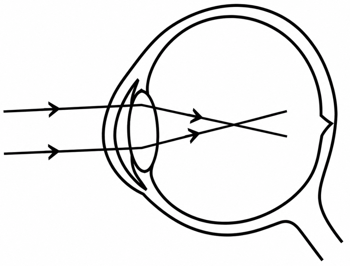 Given below is a diagram depicting a defect of the human eye. Study the same and answer the questions that follow:. Improvement Paper 2026, ICSE Biology 2026 Improvement Paper Solved.