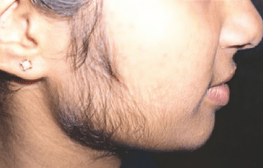 A 17-year-old girl was having irregular menstrual cycle. Her mother took her to their family physician. She was diagnosed with adrenal virilism. Study the picture given below and answer the following question: ICSE 2026 Biology Solved Question Paper.