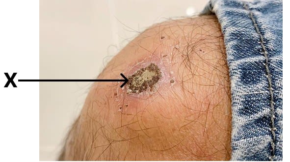 Madhu fell down while playing in the school playground and injured her knee. There was bleeding from the injured part but after some time a brown thick layer was formed on the injury to stop the bleeding. ICSE 2025 Biology Solved Question Paper.