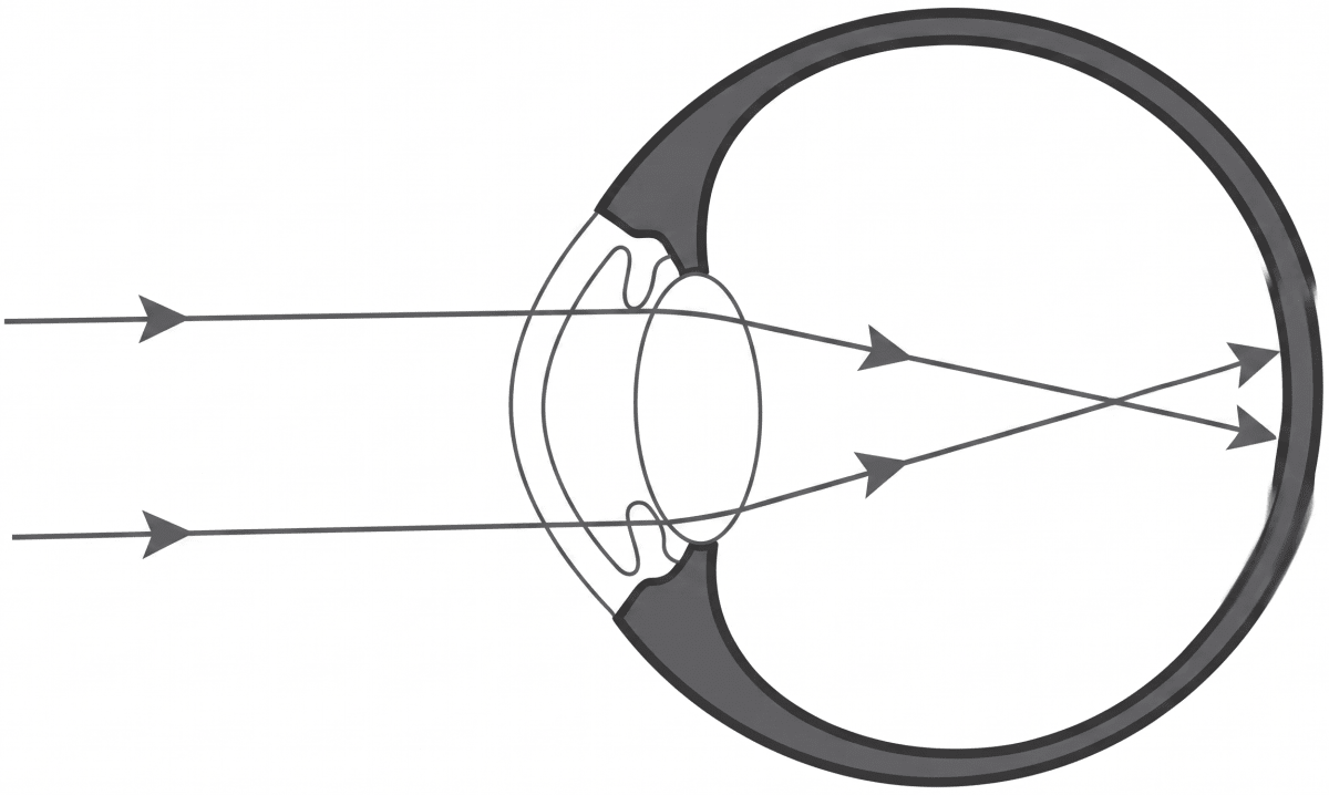 A biology teacher had shown a chart of an eye defect in the classroom and asked the students to identify it and suggest a corrective lens for the same. Which of the following will be the correct response? ICSE Concise 10 Biology Model Paper.