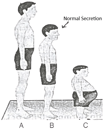 Human height is mainly controlled by genetic factors but hormonal secretion is also equally important in regulating the height. Study the figures given below and answer the questions that follow : Genetics, Concise Biology Solutions ICSE Class 10.