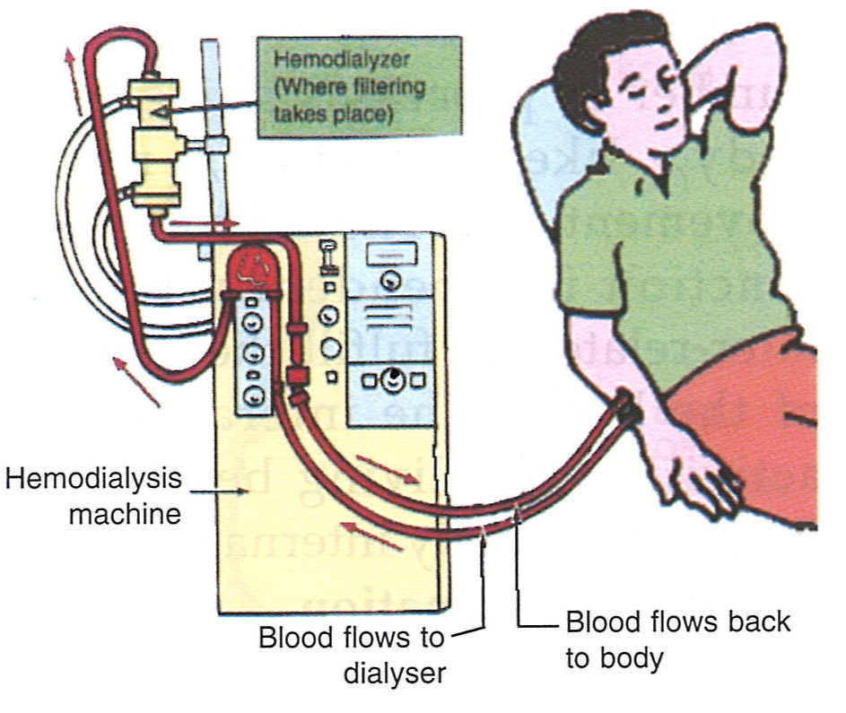 The figure shown alongside represents a process for the treatment of a person. Study the same and answer the following questions. Concise Biology Solutions ICSE Class 7.