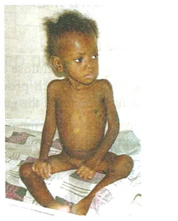 Given below is a photo of a child suffering from a deficiency disease. Read the information below and fill in the blanks. Concise Biology ICSE Class 9.