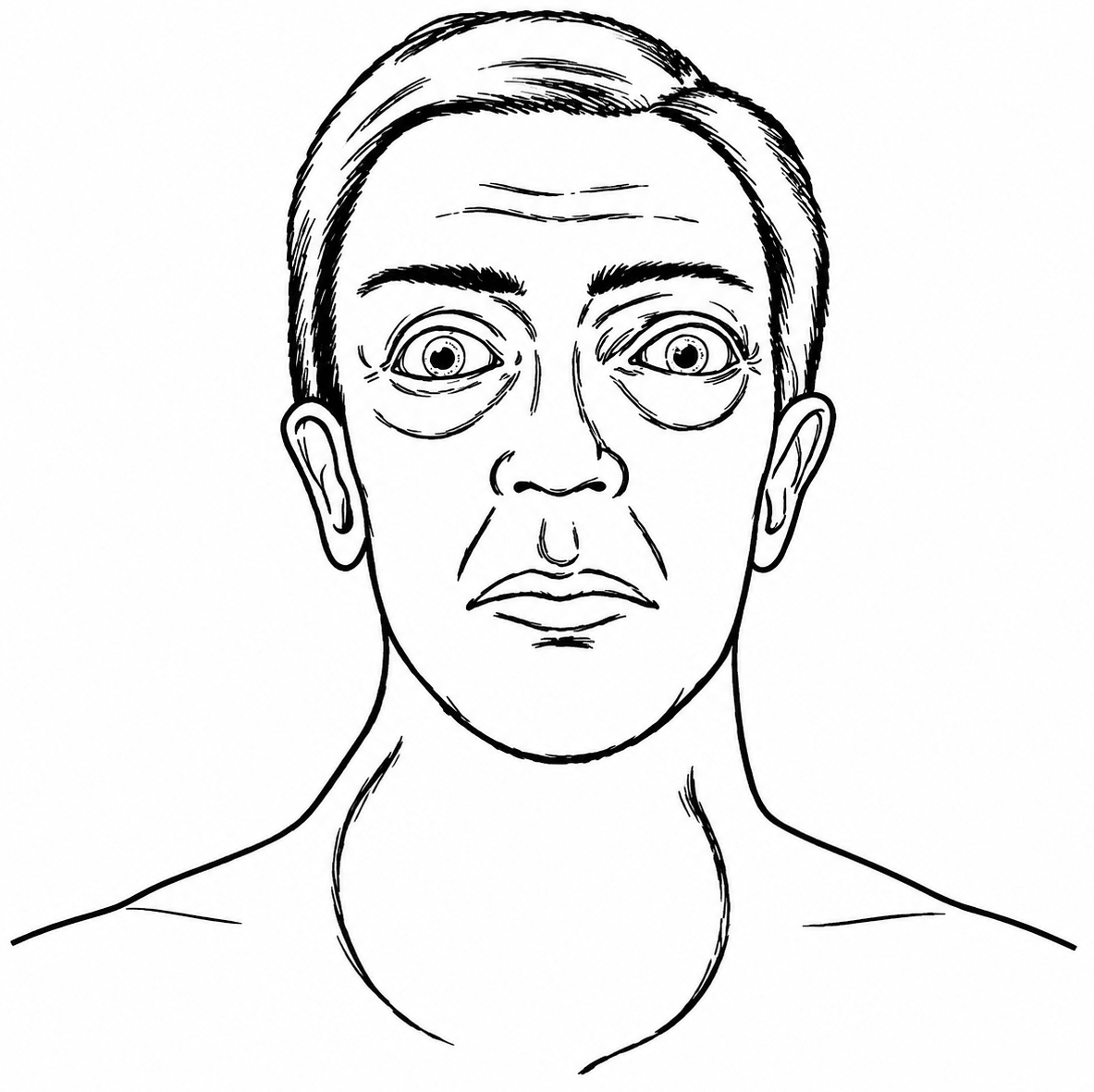 Observe the following picture, identify the defect and the cause of the defect. Endocrine System, ICSE Class 10 Biology by Goyal Brothers Solutions.