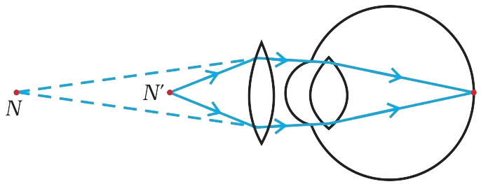 It is observed that the power of an eye to see nearby objects as well as far off objects diminishes with age. (i) Give reason for the above statement. (ii) Name the defect that is likely to arise in the eyes in such a condition. (iii) Draw a labelled ray diagram to show the type of corrective lens used for restoring the vision of such an eye. CBSE 2023 Science Class 10 Question Paper Solved.